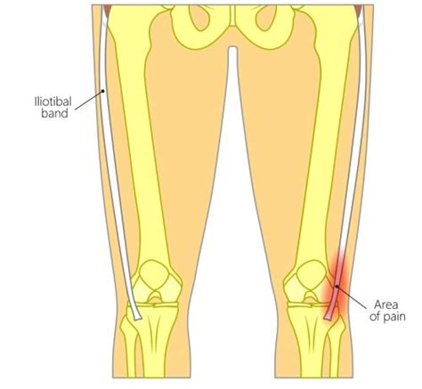 itb friction syndrome symptoms